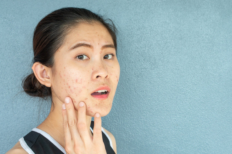 Natuurlijke oplossing voor acne