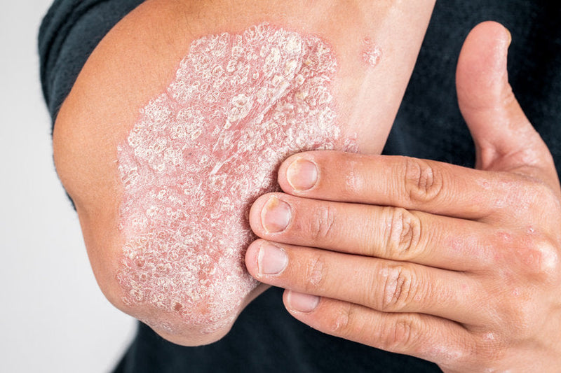 Natuurlijke behandeling Psoriasis